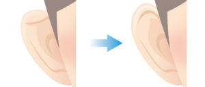 折れ耳修正とは