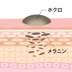 ほくろ・イボ除去