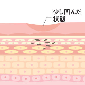 ほくろ・イボ除去