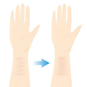 傷跡修正について