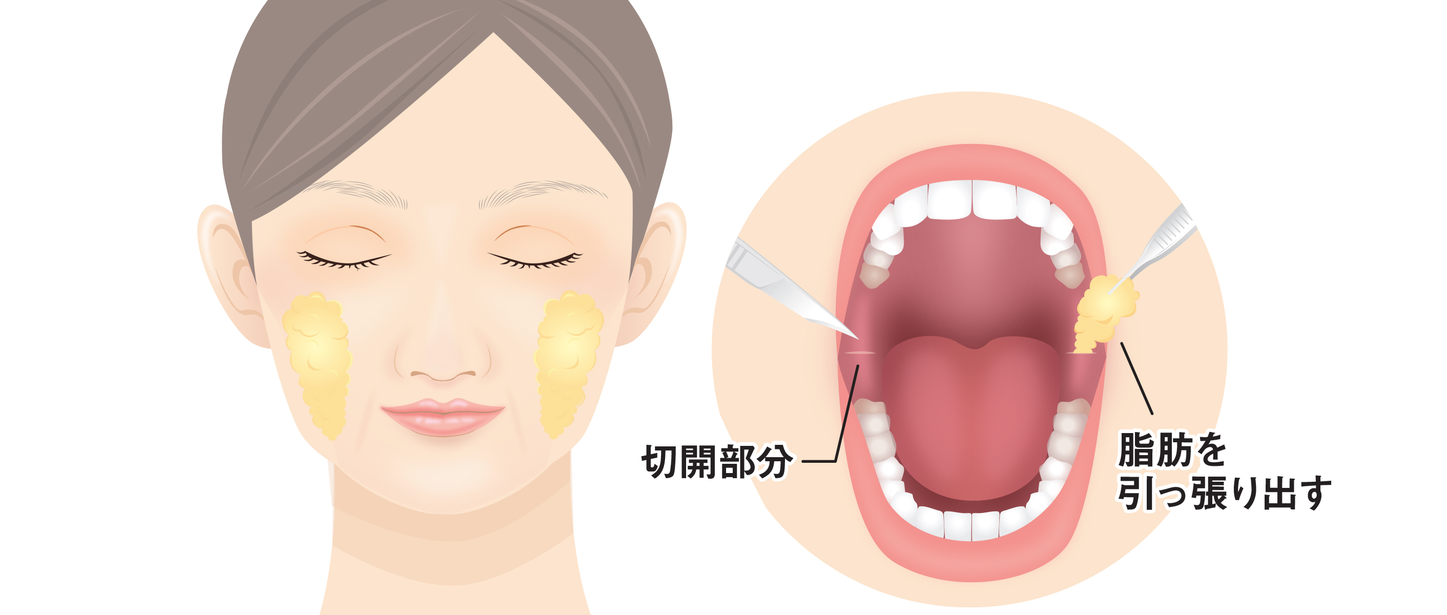 バッカルファット