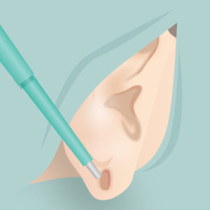 ピアス穴修正（施術１）