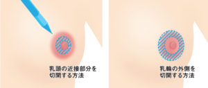 乳輪縮小（マーキング・デザイン）