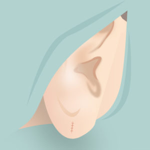 ピアス穴修正（施術2）