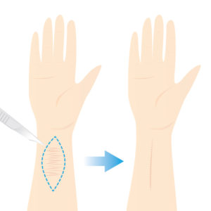 リストカット傷跡修正