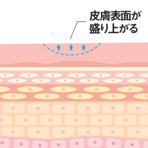 ほくろ・イボ除去