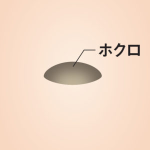 ほくろ・イボ除去