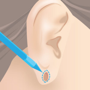 ピアス穴修正（マーキング）