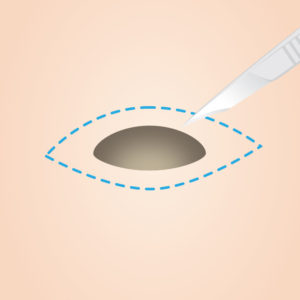 ほくろ・イボ除去