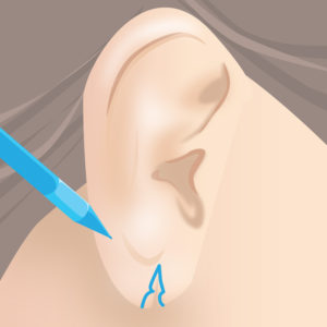 ピアス裂け修正（マーキング）
