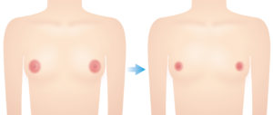 乳輪縮小の効果