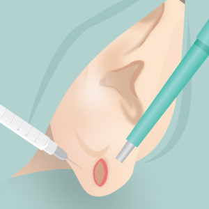 ピアス穴修正（麻酔・手術）