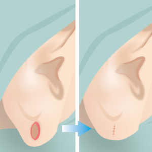 ピアス穴修正（縫合）