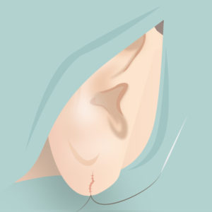 ピアス裂け修正（縫合）