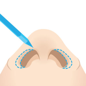 鼻孔縁挙上 マーキング・デザイン