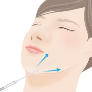 メーラーファット除去