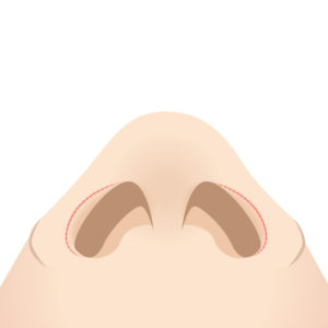 鼻孔縁挙上 縫合