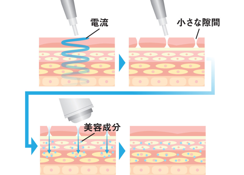 デルマシオ（エレクトロポーレーション）とは