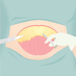 腹部切除・臍形成(タミータック)