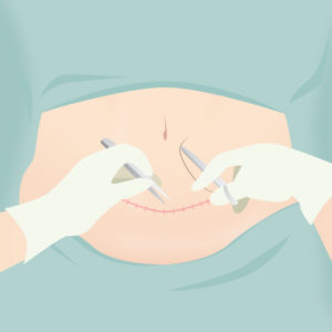 腹部切除・臍形成(タミータック)