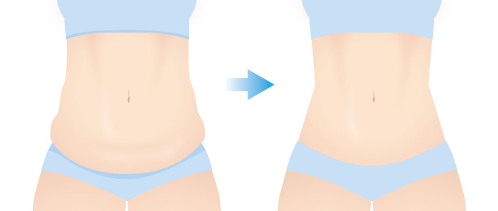 腹部切除・臍形成(タミータック)