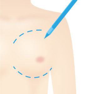 脂肪注入豊胸術|マーキング・デザイン