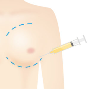 脂肪注入豊胸術|脂肪注入