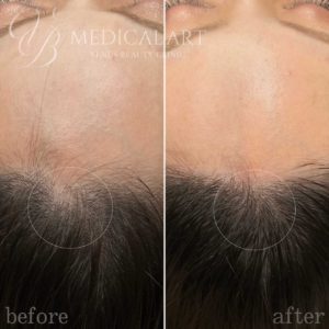 ヘアアートメイク頭頂部