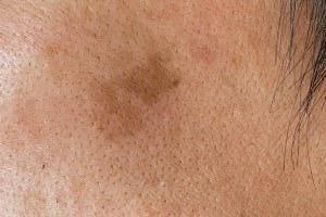 ピコレーザー施術前