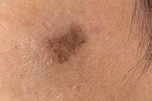 ピコレーザー施術後1週間