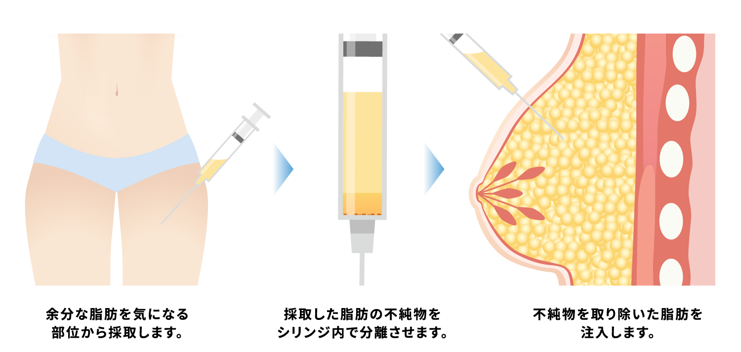 脂肪採取箇所〜ハイブリッド法