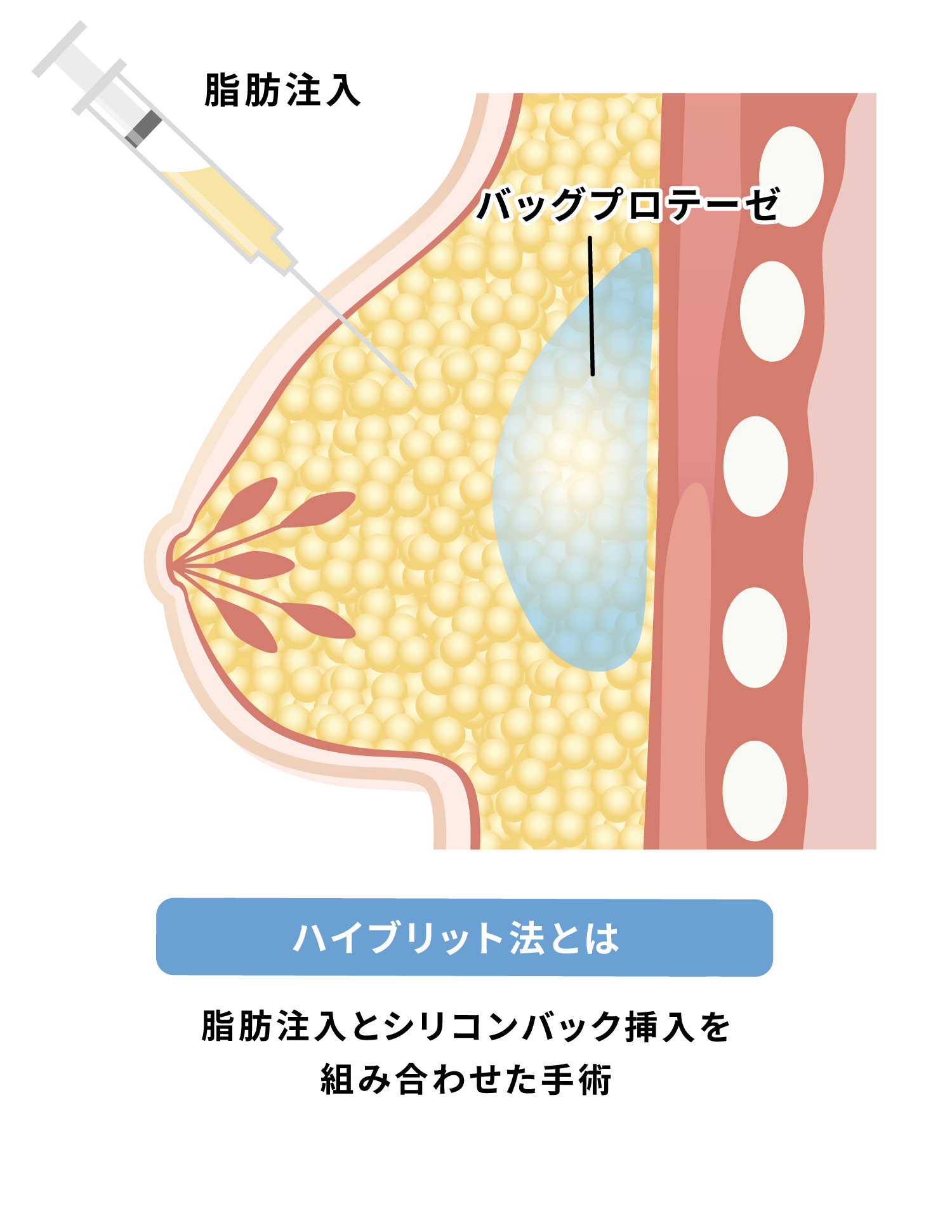 ハイブリッド法〜シリコン豊胸
