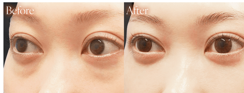 クマとりbefore after