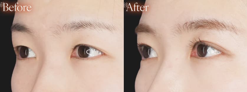 二重整形before after