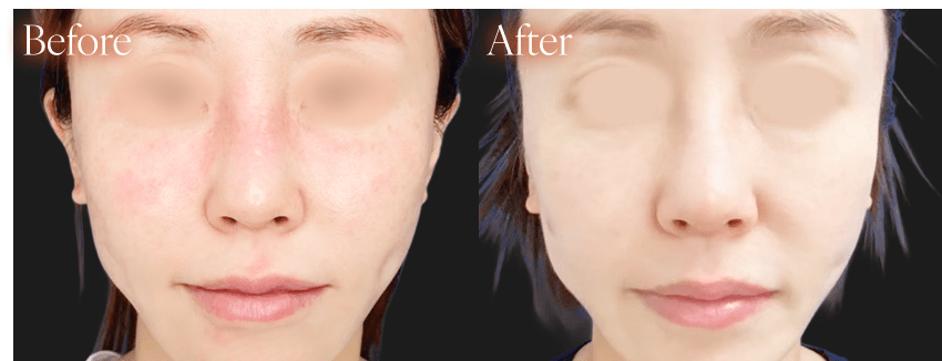 フォトフェイシャルbefore after