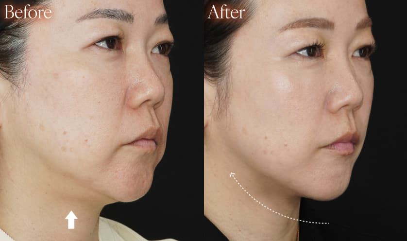 糸リフトbefore after