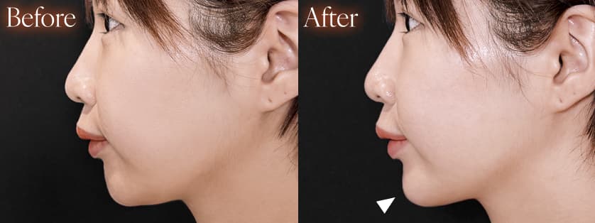 ヒアルロン酸注入before after