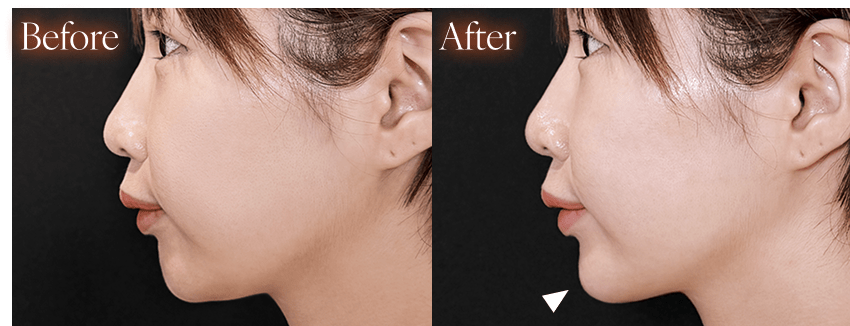 ヒアルロン酸before after