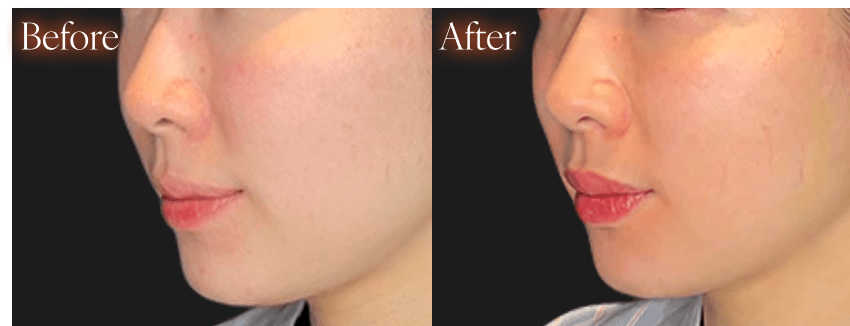 ボトックスbefore after