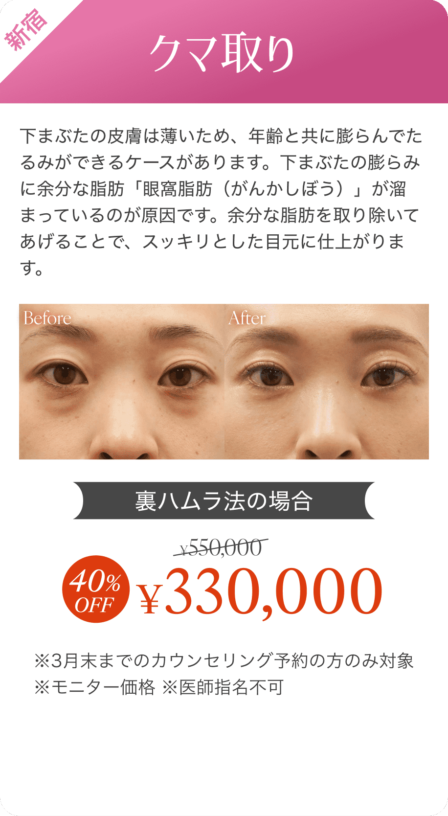 クマ取り40%オフ