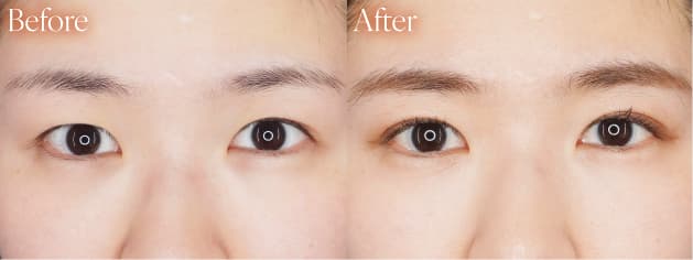 二重整形before after