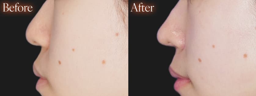 鼻施術before after