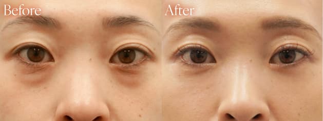 鼻施術before after