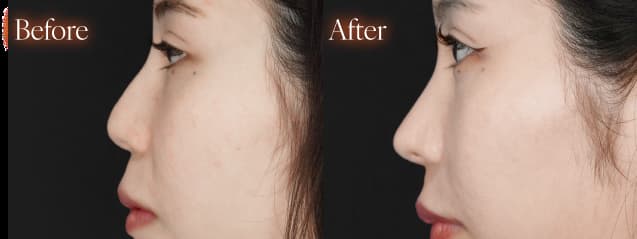 鼻施術before after