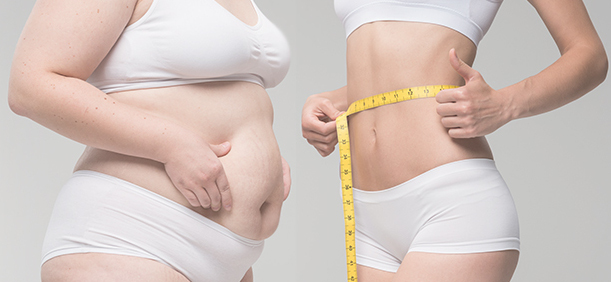 腹部切除・臍形成（タミータック）