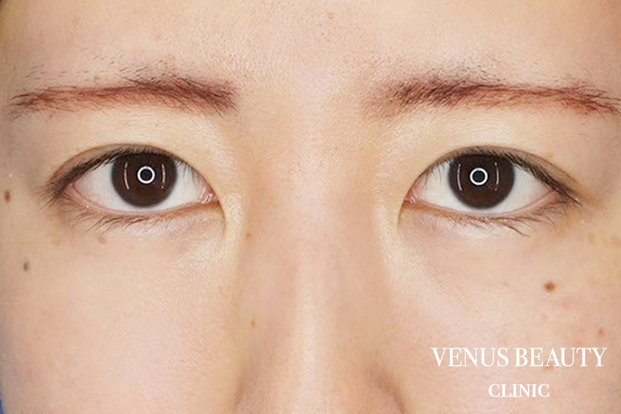 二重まぶた埋没法 施術後