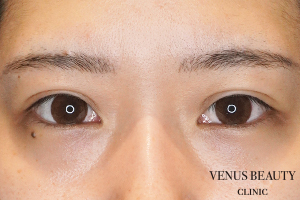 二重まぶた埋没法 施術後