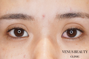 眼瞼下垂症 施術前