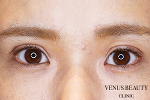 眼瞼下垂症 施術後