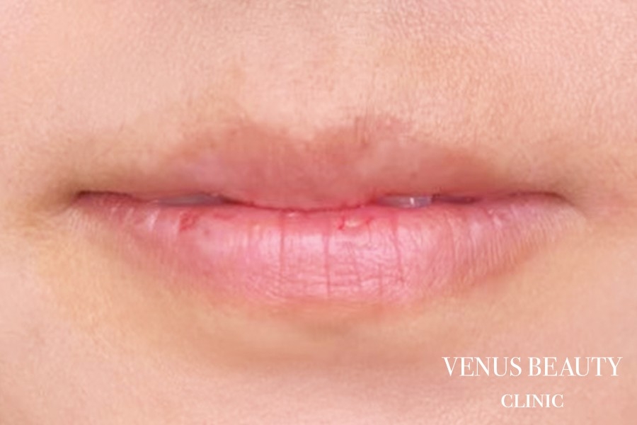 リップアートメイク 施術前